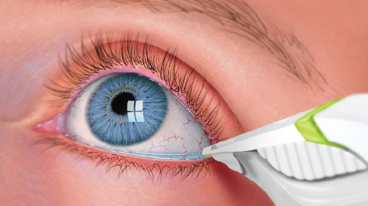 3 Common Eye Infections - Their Symptoms and Treatment