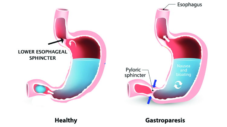 Evaluation of Diagnostic Methods and Dietary Treatment of Diabetic Gastroparesis