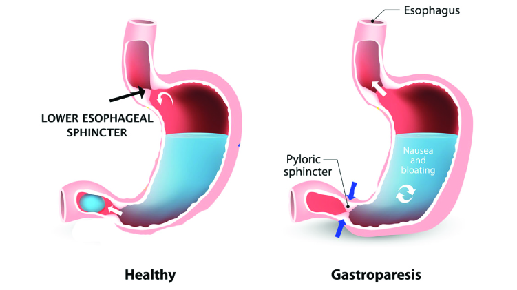 diabetic gastroparesis surgery